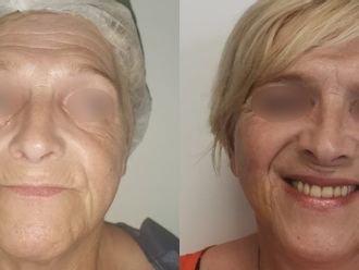 Lifting avant et après - 829735