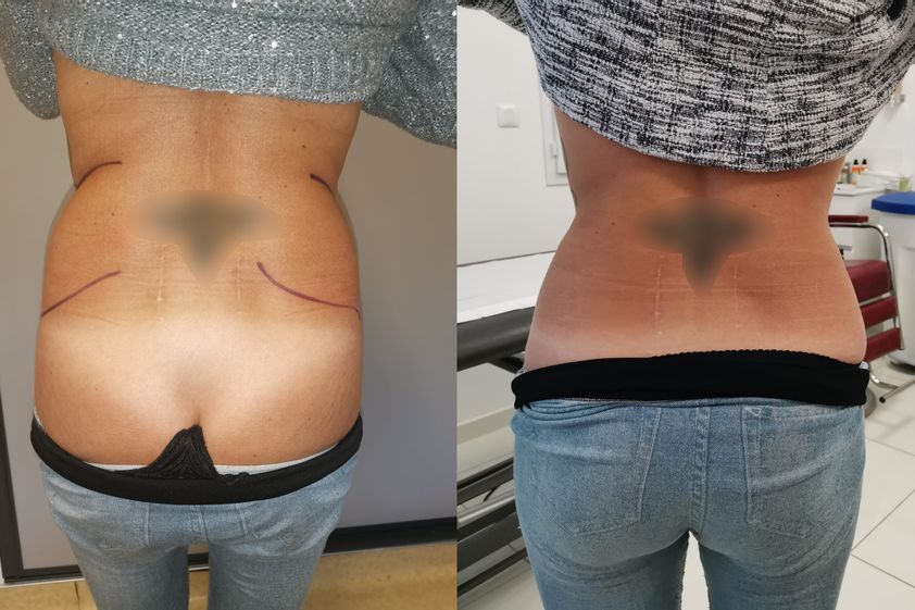Liposuccion avant et après - 829737