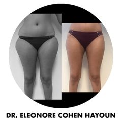 Liposuccion - Dr Éléonore Cohen-Hayoun