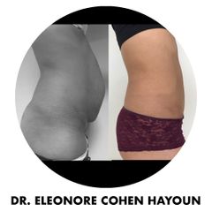 Liposuccion - Dr Éléonore Cohen-Hayoun