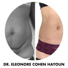 Liposuccion - Dr Éléonore Cohen-Hayoun