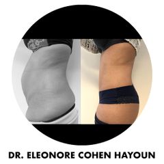 Liposuccion - Dr Éléonore Cohen-Hayoun