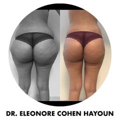 Liposuccion - Dr Éléonore Cohen-Hayoun