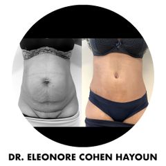 Liposuccion - Dr Éléonore Cohen-Hayoun