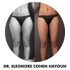Liposuccion - Dr Éléonore Cohen-Hayoun