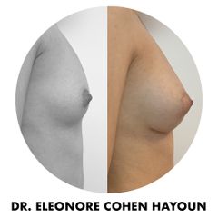 Augmentation mammaire - Dr Éléonore Cohen-Hayoun
