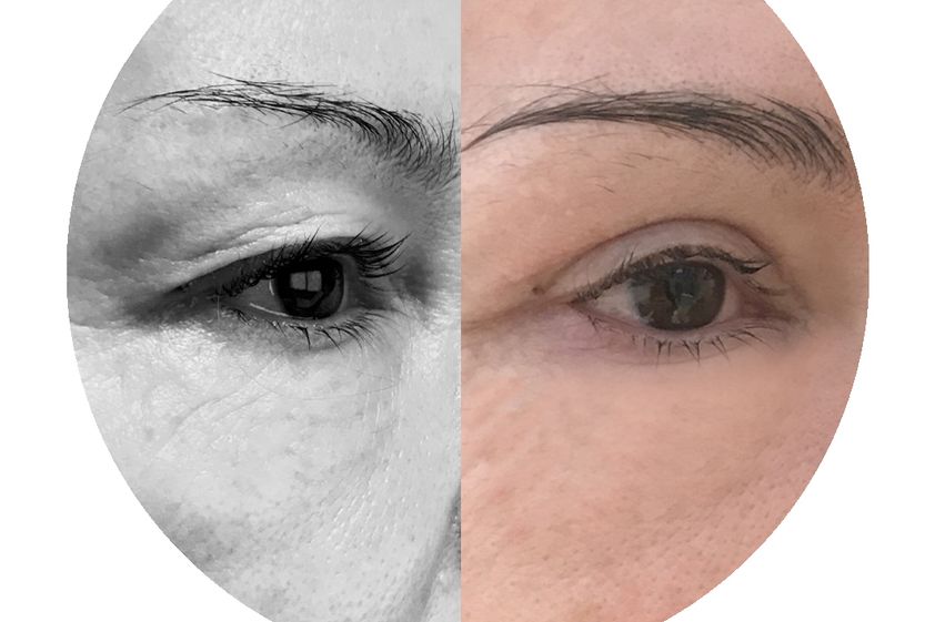 Blépharoplastie avant et après - 858384