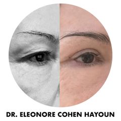 Blépharoplastie - Dr Éléonore Cohen-Hayoun