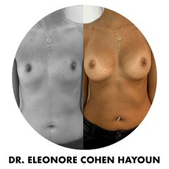 Augmentation mammaire - Dr Éléonore Cohen-Hayoun