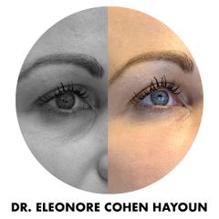 Cernes - Dr Éléonore Cohen-Hayoun