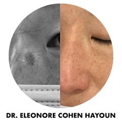 Taches pigmentaires - Dr Éléonore Cohen-Hayoun
