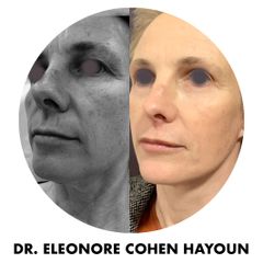 Lifting - Dr Éléonore Cohen-Hayoun