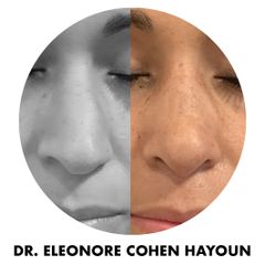 Rhinoplastie médicale - Dr Éléonore Cohen-Hayoun