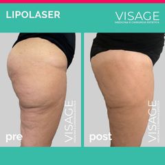 Liposuccion - Visage - Médecine et chirurgie esthétique