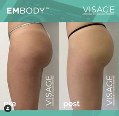 Radiofréquence - Visage - Médecine et chirurgie esthétique