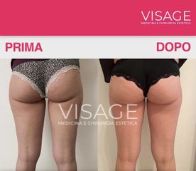 Traitement anti-cellulite - Visage - Médecine et chirurgie esthétique