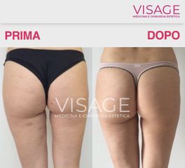Traitement anti-cellulite - Visage - Médecine et chirurgie esthétique