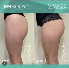 Radiofréquence - Visage - Médecine et chirurgie esthétique