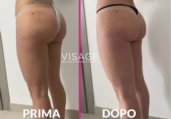 Traitement anti-cellulite - Visage - Médecine et chirurgie esthétique