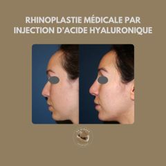 Rhinoplastie médicale par injection d'acide hyaluronique