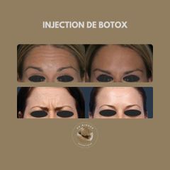 Injection de Botox