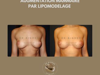 Augmentation mammaire avant et après - 874042
