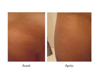 Vergetures avant et après - 576623