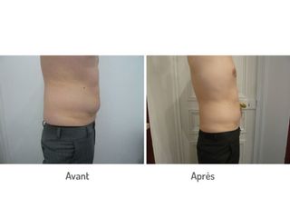 Avant après traitement cryolipolyse