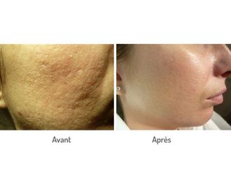 Traitement anti-acné - 576626