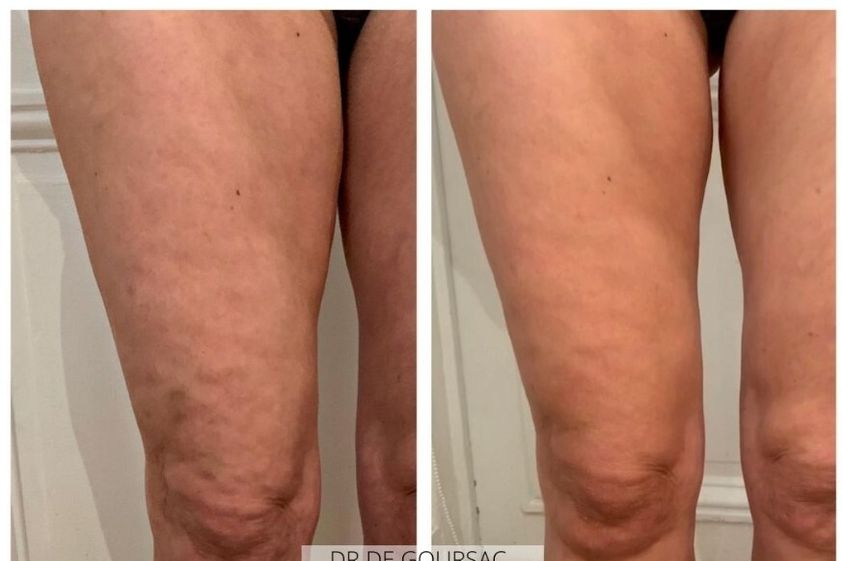 Traitement anti-cellulite avant et après - 826584