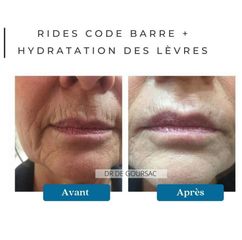Augmentation des lèvres - Dr Catherine de Goursac