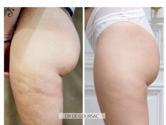 Traitement anti-cellulite avant et après - 827535