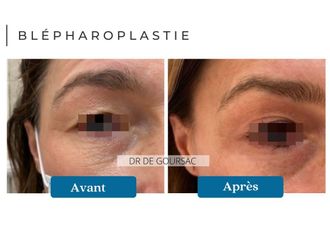 Blépharoplastie avant et après - 872190