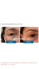 Blépharoplastie Dr De Goursac