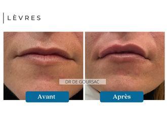 Augmentation des lèvres avant et après - 872234