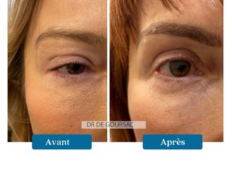 Blépharoplastie avant et après - 872237