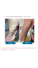 Radiofréquence Attiva