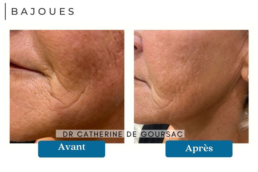 Acide Hyaluronique avant et après - 873002