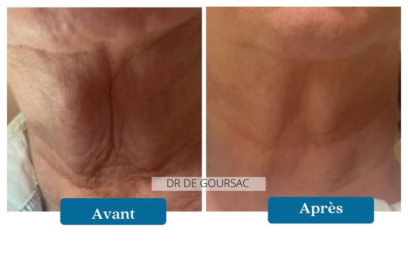 Traitement anti-rides avant et après - 873004