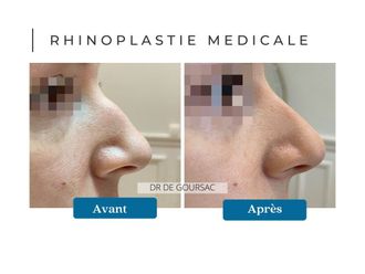 Rhinoplastie médicale avant et après - 873089