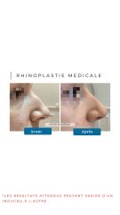 Rhinoplastie Médicale Dr Catherine De Goursac