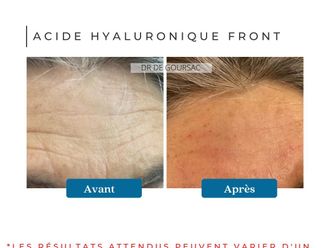 Acide Hyaluronique avant et après - 873092