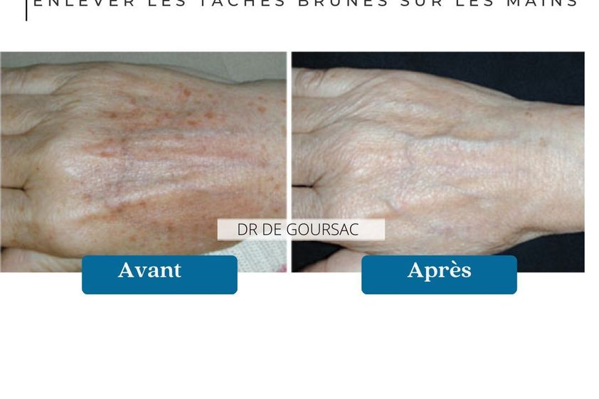 Taches pigmentaires avant et après - 873395
