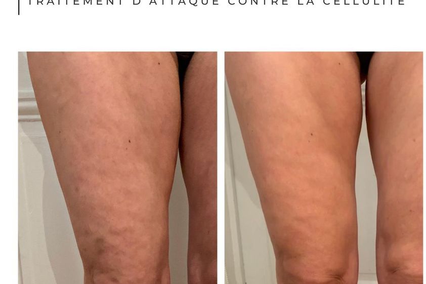 Traitement anti-cellulite avant et après - 873396