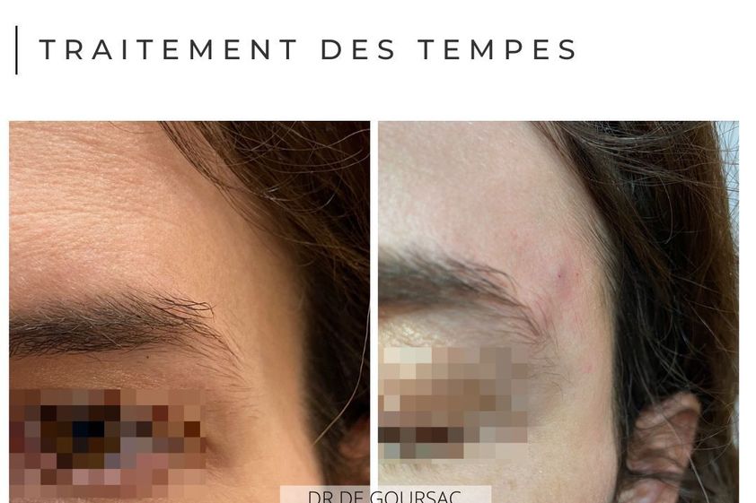 Acide Hyaluronique avant et après - 873541