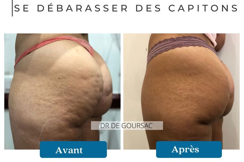 Traitement anti-cellulite avant et après - 873545