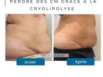 Cryolipolyse avant et après - 873744