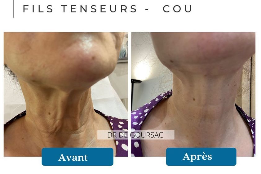Fils tenseurs avant et après - 873747
