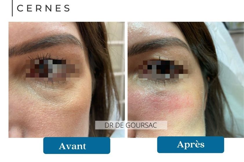 Cernes avant et après - 873833