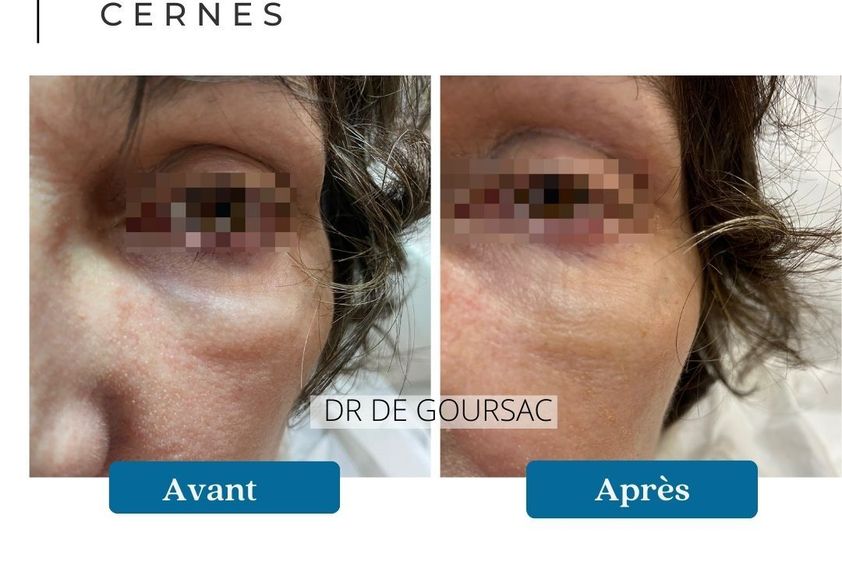 Cernes avant et après - 873838